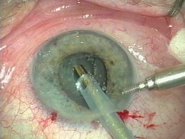 http://www.eyes-and-vision.com/catrctsurgery.jpeg