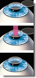 the three basic steps in laser eye surgery