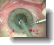 a catarct surgery procedure