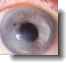 keratitis eye disorder